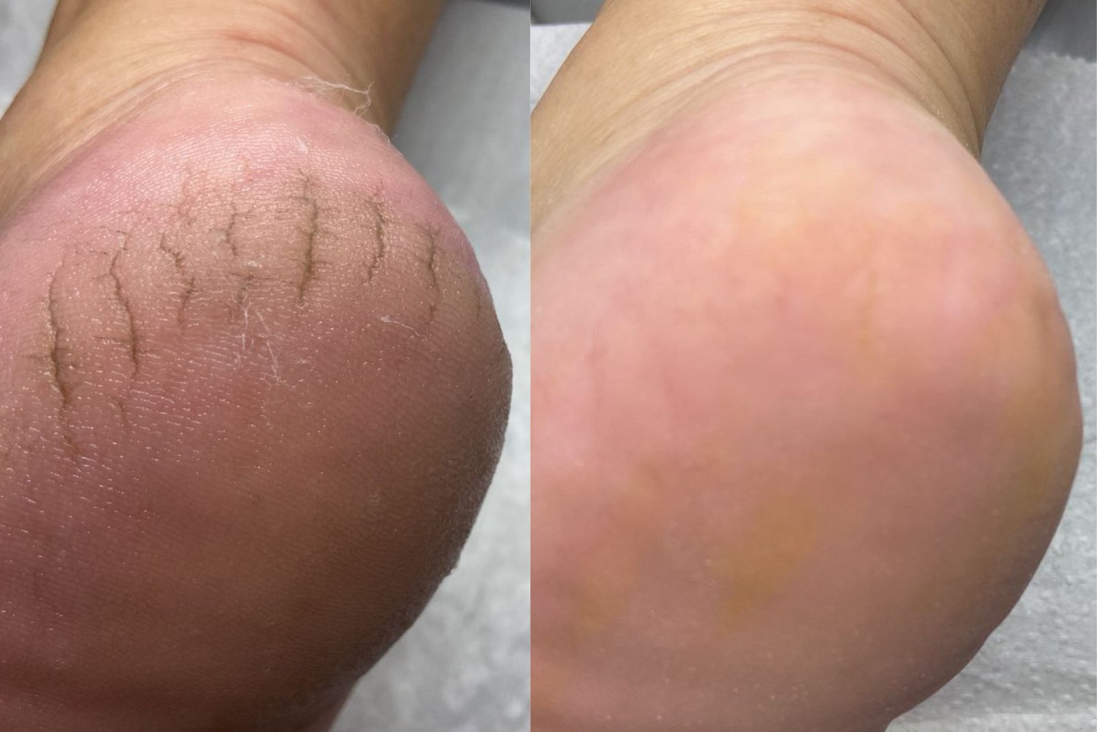 Peeling Químico nos Pés em Itajaí