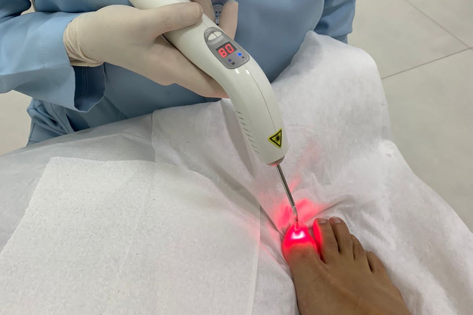 Laserterapia na podologia em Itajaí